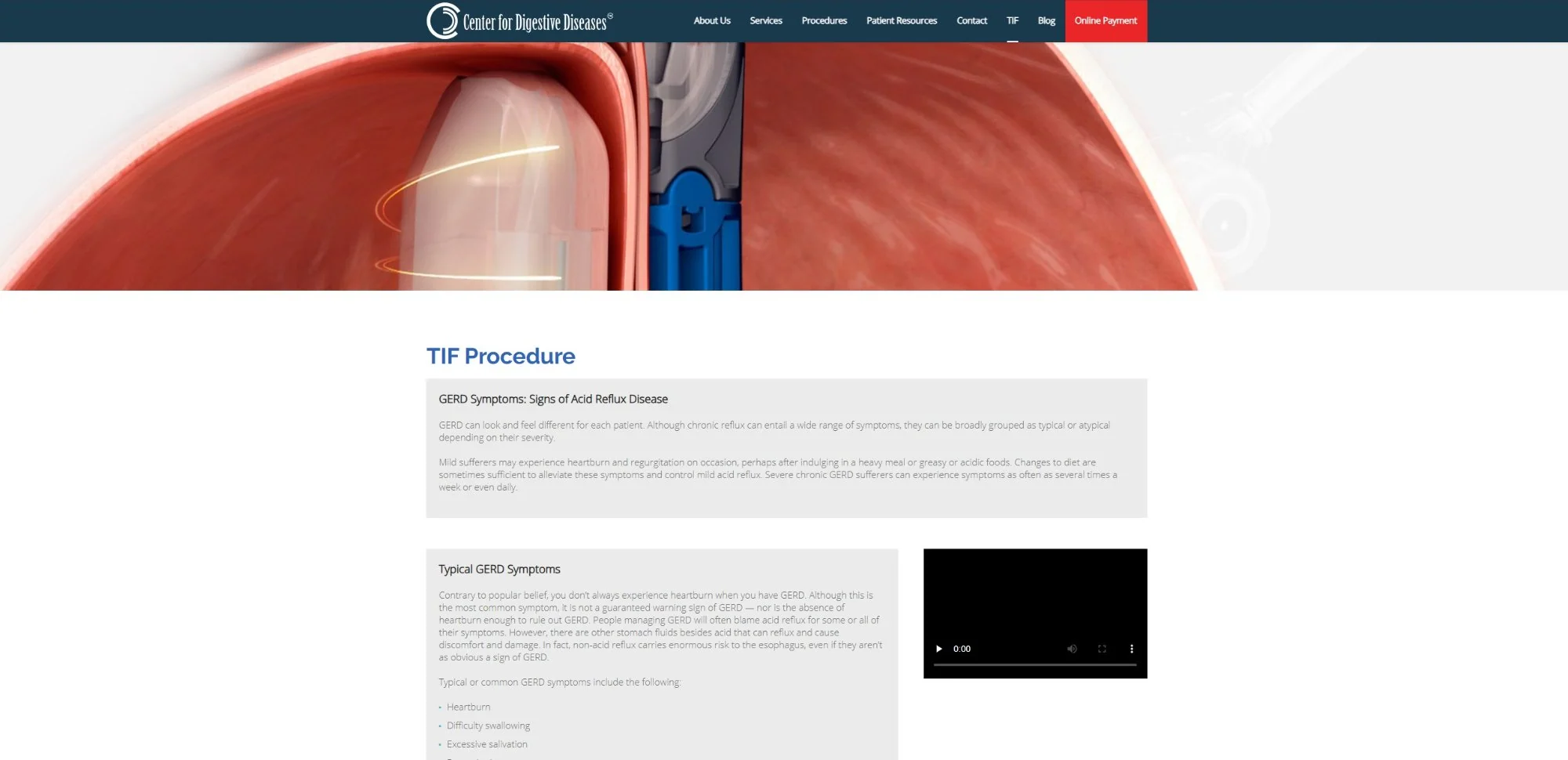 CDD TIF Procedure page
